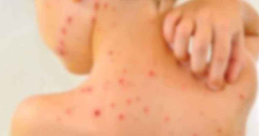 Semsa investiga dois casos suspeitos de sarampo em Manaus