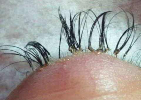Mulher perde fios após alongamento de cílios dar errado e faz alerta
