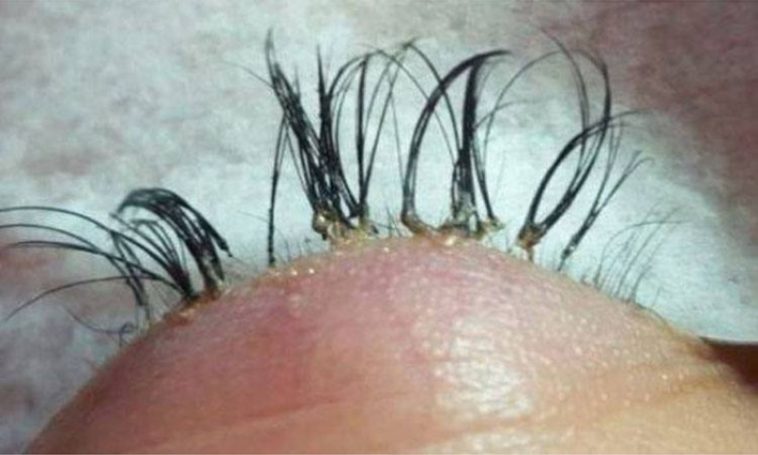 Mulher perde fios após alongamento de cílios dar errado e faz alerta