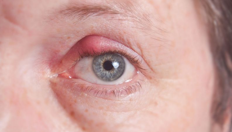 O que é aquela bolinha que nasce na pálpebra? Por que surge? Tem cura?