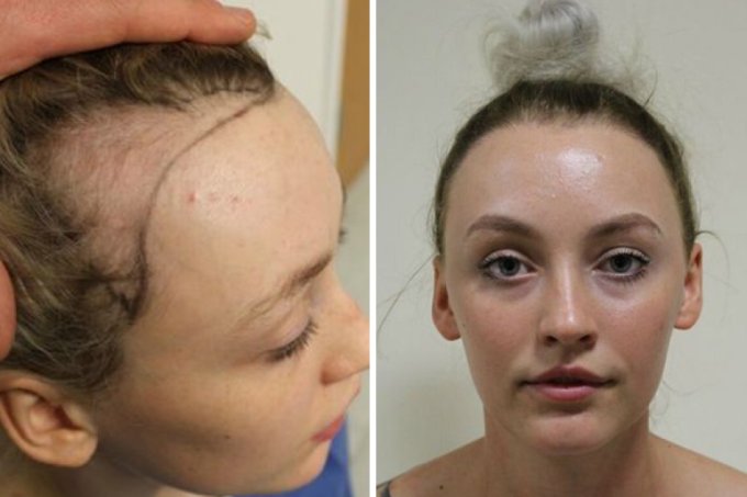 Bailarina revela o que fez perder parte do seu cabelo