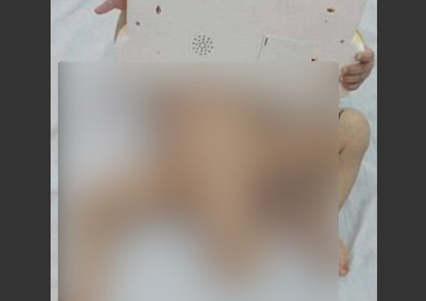 Bebê com três pernas passa por cirurgia de 10 horas