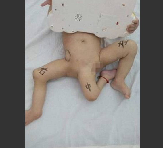 Bebê com três pernas passa por cirurgia de 10 horas