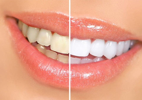 Mitos e verdades sobre clareamento dental