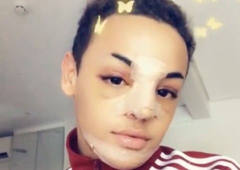 Pabllo Vittar passa por três cirurgias no rosto