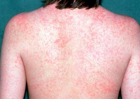 Confirmados quatro casos de sarampo em Manaus