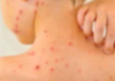 Saiba cuidados e procedimentos contra o Sarampo