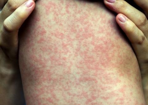 Saiba quais são os bairros de Manaus que registraram os primeiros casos de sarampo