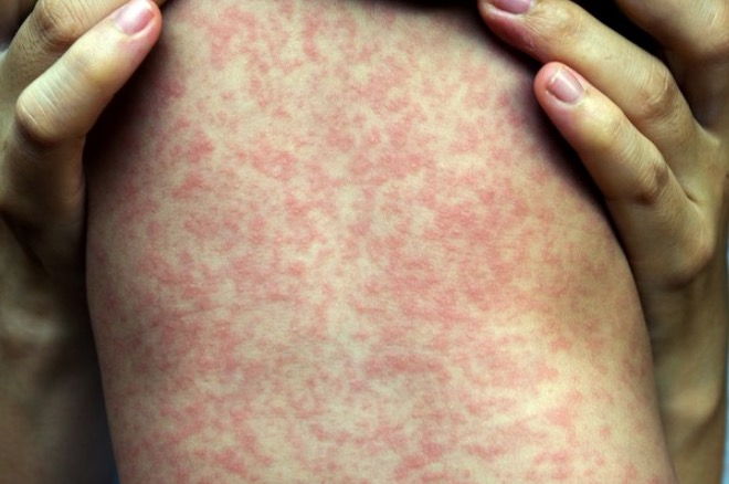 Saiba quais são os bairros de Manaus que registraram os primeiros casos de sarampo