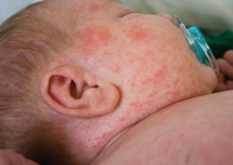 Prefeitura diminui idade para vacinação de bebês e reforça imunização contra sarampo em Manaus