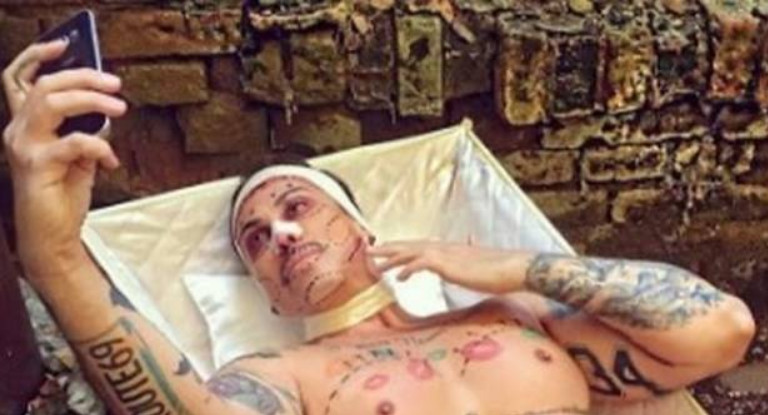 Após fazer cirurgia plástica, homem fica com ereção permanente