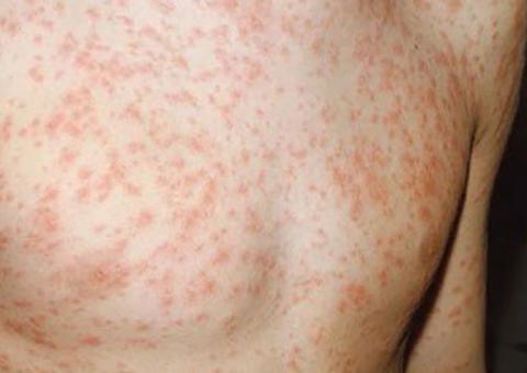 Ponto facultativo: UBSs funcionam para garantir vacinação contra Sarampo