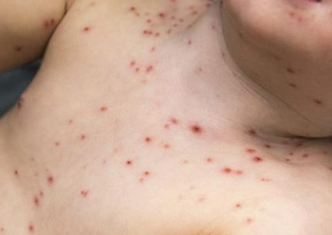  CAICs ficarão abertos na quinta-feira Santa para vacinação contra o sarampo