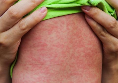 FVS atualiza para 61 número de casos suspeitos de sarampo no Amazonas