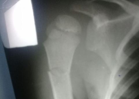 Mulher é presa após ser acusada de quebrar braço do próprio filho no Amazonas