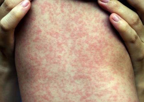 Sobe para 103 o número de casos suspeitos de sarampo em Manaus