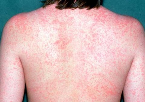 Coren Amazonas realiza vacinação gratuita contra o sarampo na Praça da Polícia