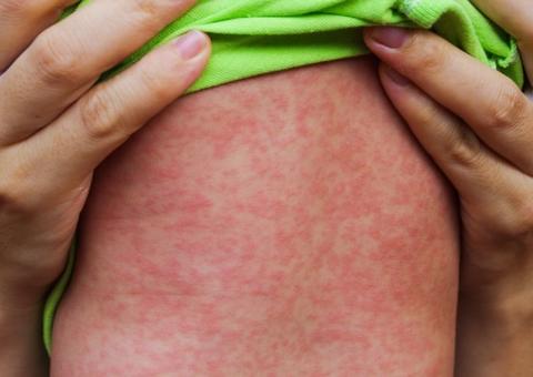 Prefeitura e Pastoral da Criança promovem oficinas sobre sarampo em Manaus