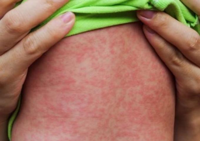 Número de casos suspeitos de sarampo em Manaus sobe para 183