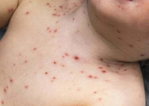 Crianças de até cinco anos de idade representam 71% dos casos de sarampo em Manaus