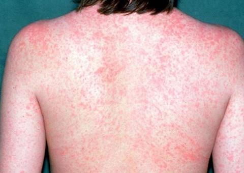 OMS alerta para proliferação de surto de sarampo na fronteira entre Brasil e Venezuela