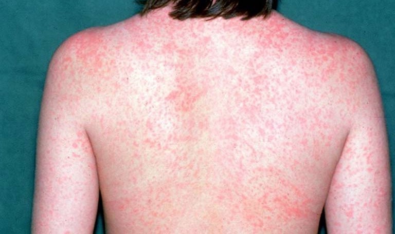 OMS alerta para proliferação de surto de sarampo na fronteira entre Brasil e Venezuela