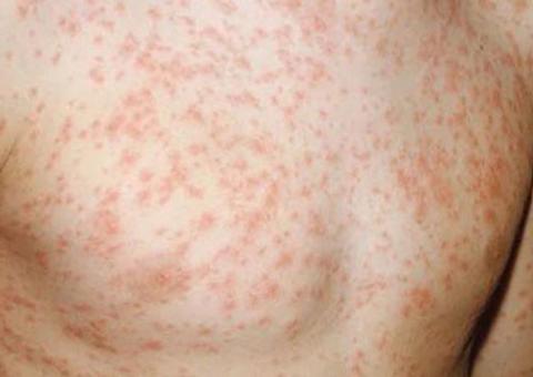 Casos suspeitos de sarampo chegam a 192 no Amazonas