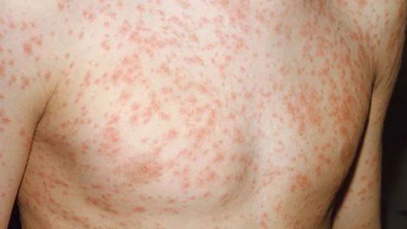 Casos suspeitos de sarampo chegam a 192 no Amazonas