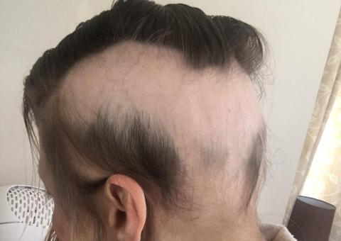 Mulher perde quase todo cabelo e motivo é bizarro