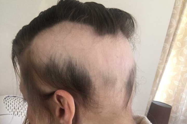 Mulher perde quase todo cabelo e motivo é bizarro