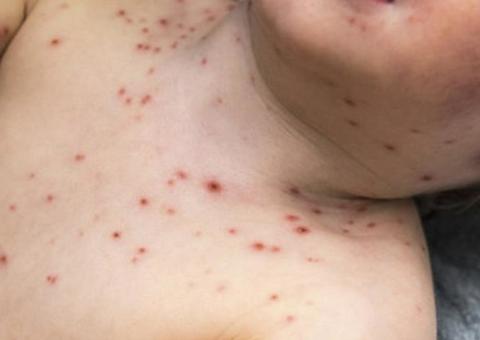 Shopping de Manaus recebe posto de vacinação contra sarampo