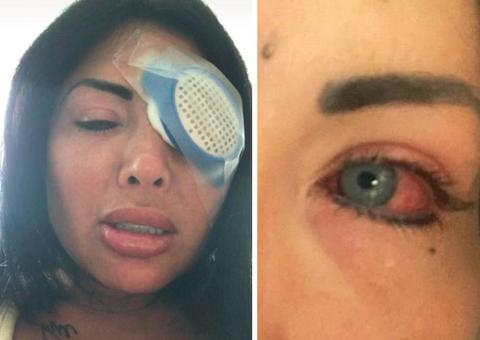 Modelo faz cirurgia para ficar com olhos claros e o pior acontece