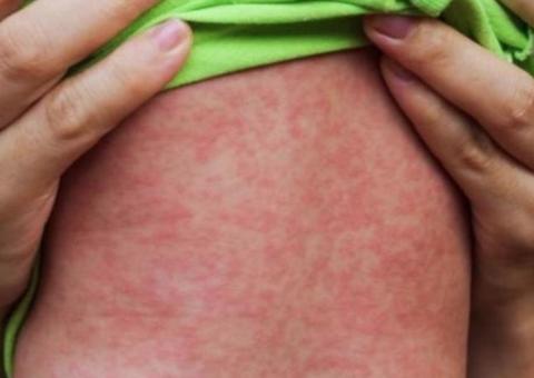 FVS confirma mais 10 casos de sarampo em Manaus