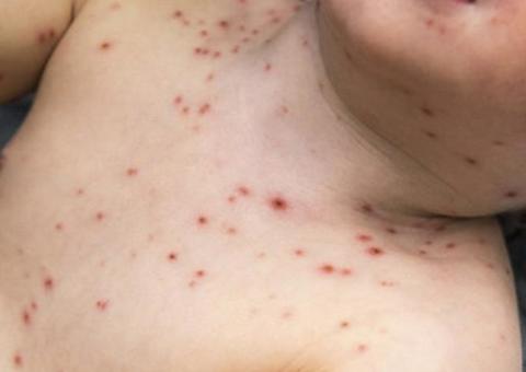 Amazonas tem 251 casos notificados de sarampo, informa FVS