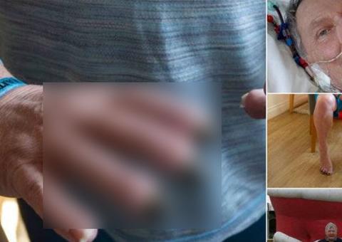 Homem perde dedos após infecção de bactéria comedora de carne