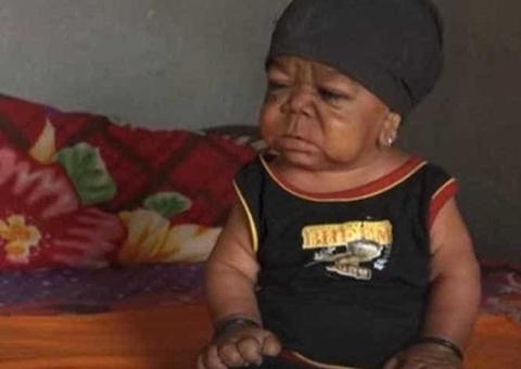 Jovem de 23 anos com doença rara é rejeitado pelo pais por ter tamanho de bebê