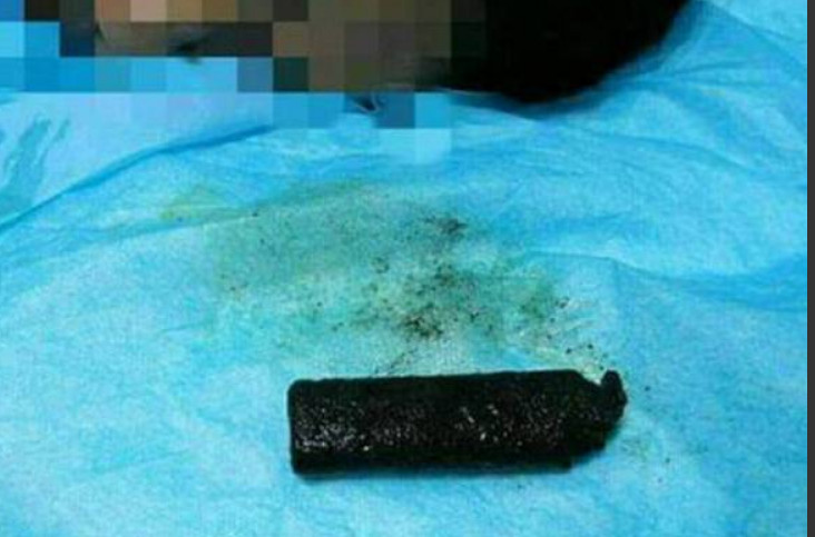 Homem passa por cirurgia para remover isqueiro de estômago após 20 anos