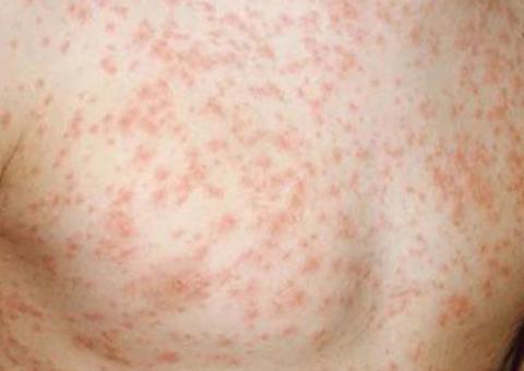 Sobe para 22 o número de casos confirmados de sarampo em Manaus