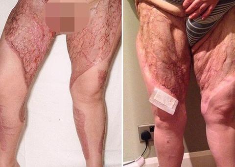 Mulher quase morre por causa de bactéria que comeu sua pele após depilação