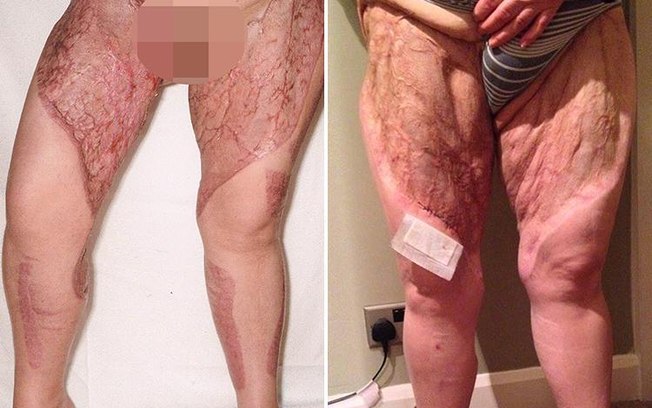 Mulher quase morre por causa de bactéria que comeu sua pele após depilação