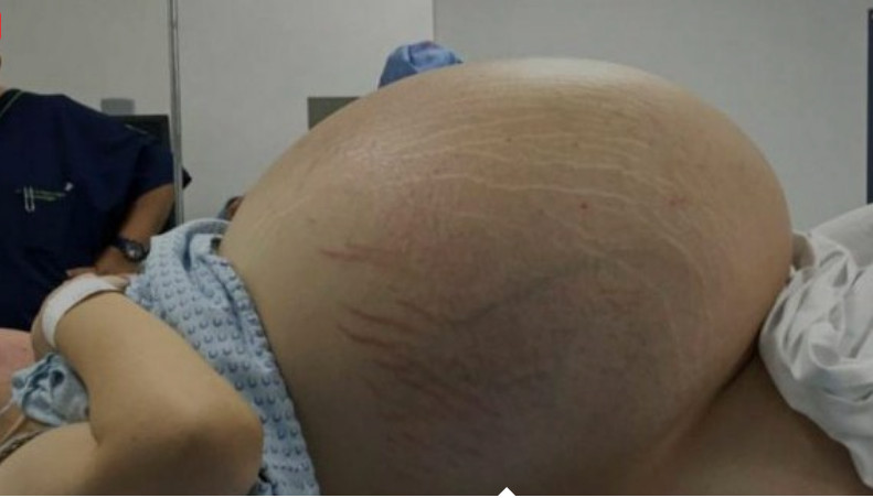 Mulher esperava 10 bebês, mas equipe médica é surpreendida ao ver ultrassom 