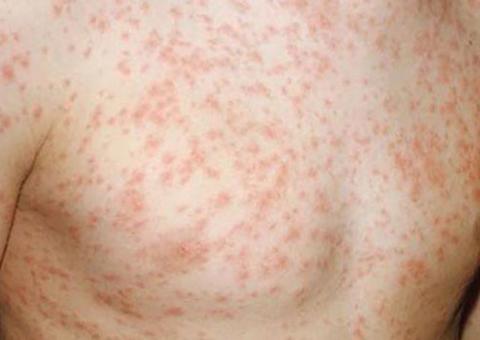 Sobe para 395 casos notificados de sarampo em Manaus 