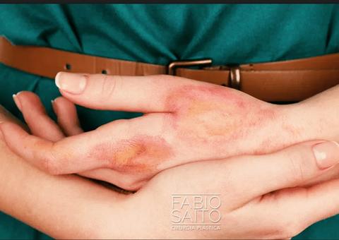 Duas mulheres ficam queimadas em explosão ao fazer sabão caseiro 