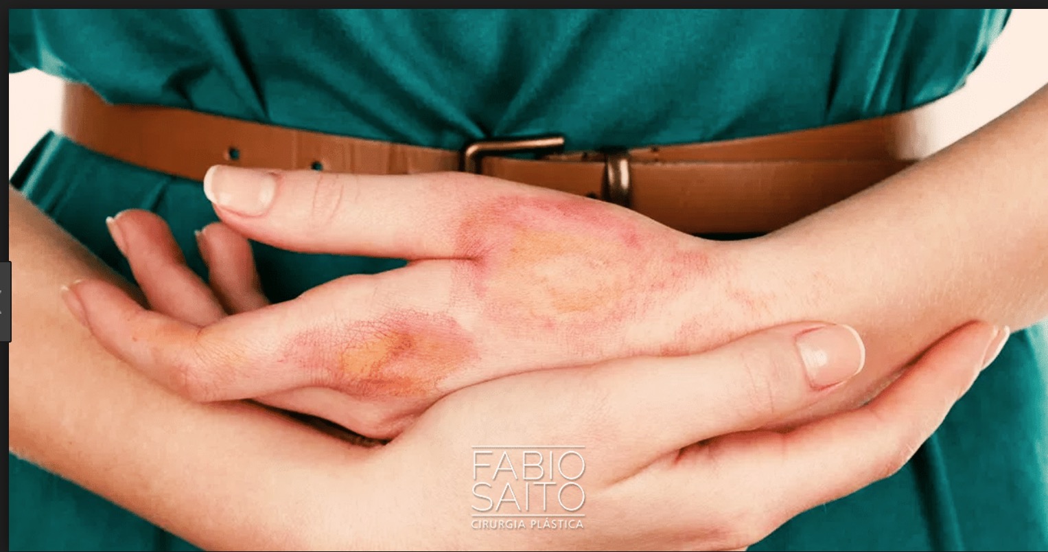 Duas mulheres ficam queimadas em explosão ao fazer sabão caseiro 