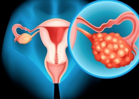 Câncer de ovário é o 6º mais frequente no Amazonas e Fcecon faz alerta