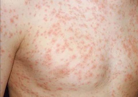 FVS registra 422 casos de sarampo no Amazonas 