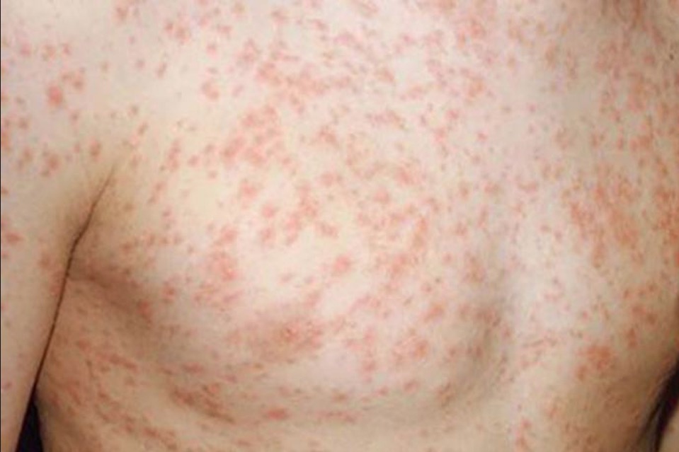 FVS registra 422 casos de sarampo no Amazonas 