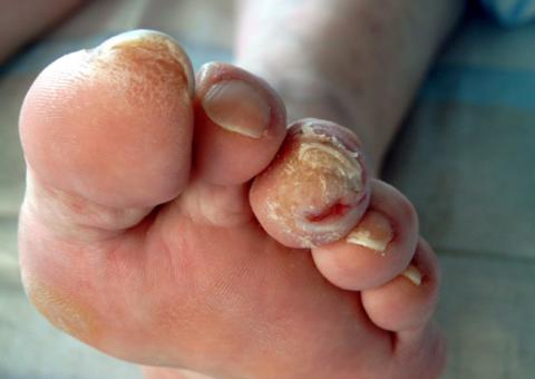 Susam cria serviço para evitar complicações em pacientes com pé diabético