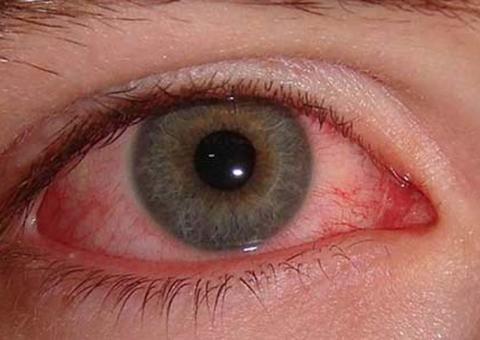 Excesso de remela nos olhos pode indicar problemas