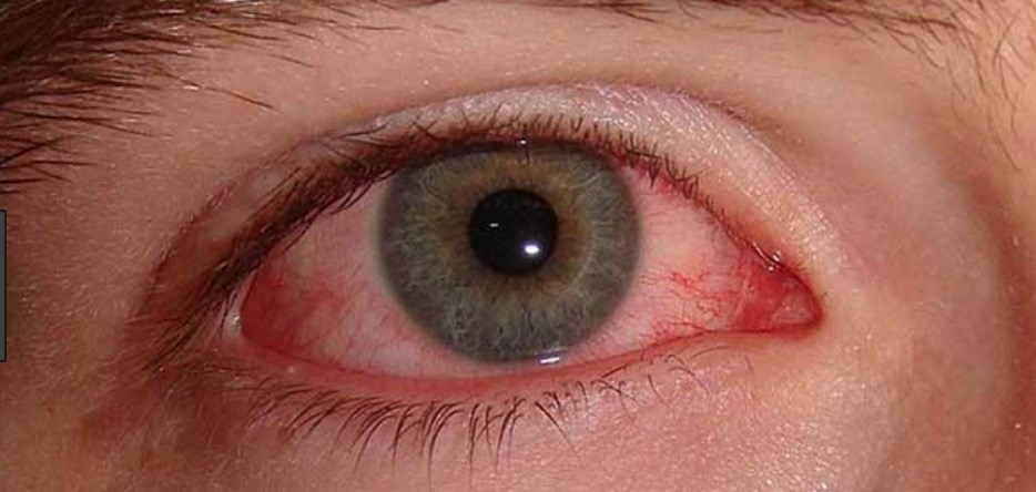 Excesso de remela nos olhos pode indicar problemas